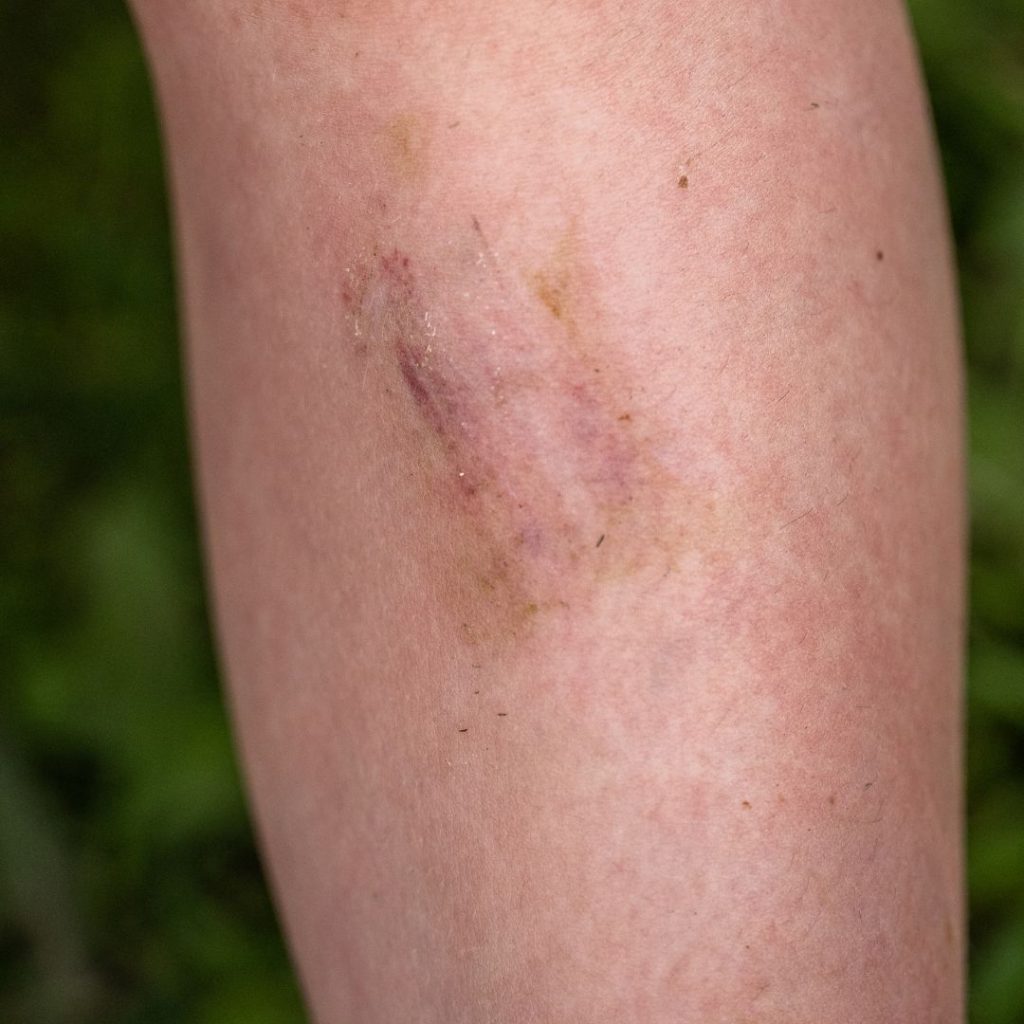 scrape and bruise on person's leg